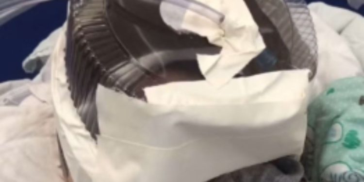 Hospital usa embalagem de bolo como máscara de oxigênio para bebê