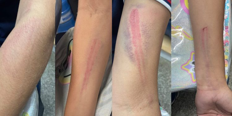 Adolescente aparece na escola cheia de hematomas nos braços após ser agredida em Manaus