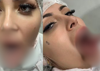 VÍDEO: Andressa Urach realiza procedimento de ‘língua de cobra’ para aumento de prazer