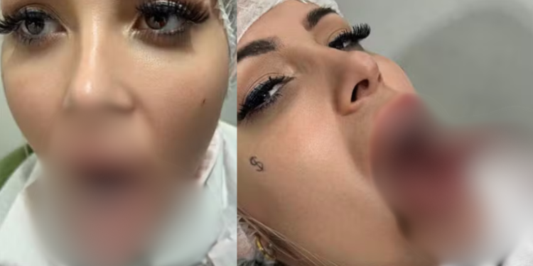 VÍDEO: Andressa Urach realiza procedimento de ‘língua de cobra’ para aumento de prazer