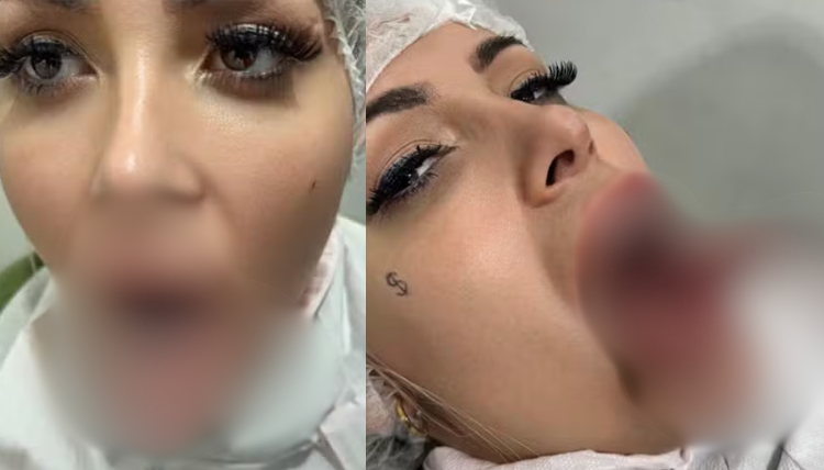 VÍDEO: Andressa Urach realiza procedimento de ‘língua de cobra’ para aumento de prazer