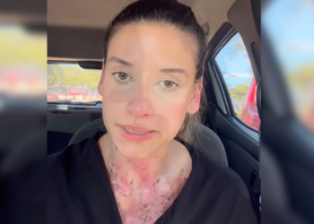 A empreendedora Luiza Britto sofreu queimaduras de segundo grau em cerca de 40% do tronco ao tentar. Vídeo: