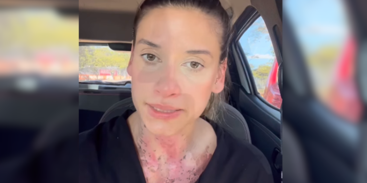 A empreendedora Luiza Britto sofreu queimaduras de segundo grau em cerca de 40% do tronco ao tentar. Vídeo: