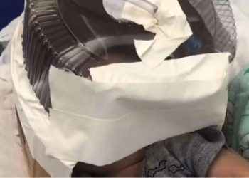 Morre bebê que usou respirador feito com embalagem de bolo 