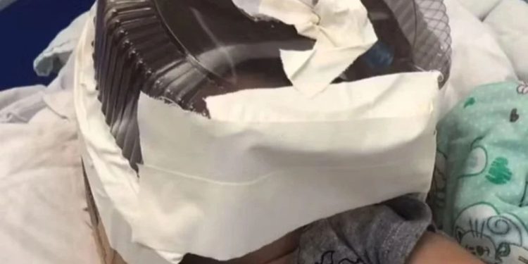 Morre bebê que usou respirador feito com embalagem de bolo