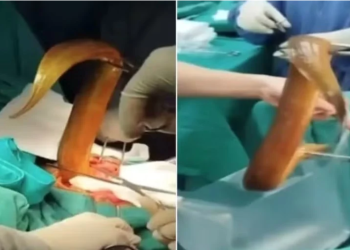 Um homem foi internado no Hospital Viet Duc em Hanói no dia 27 de julho após introduzir uma enguia viva e. Homem é