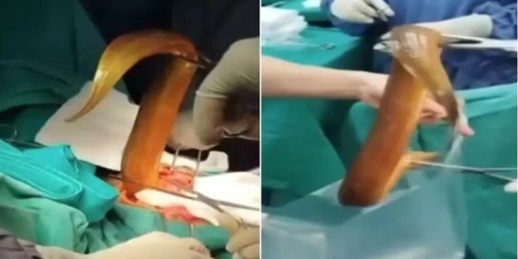 Um homem foi internado no Hospital Viet Duc em Hanói no dia 27 de julho após introduzir uma enguia viva e. Homem é