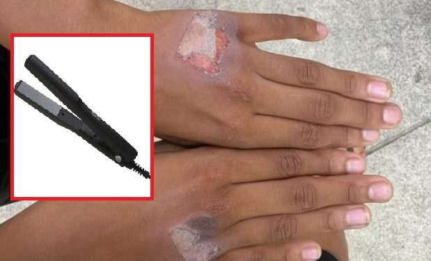 Mãe queima filho com chapinha após criança “comer iogurte sem permissão”