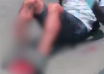 veja como ficou a perna do motociclista que colidiu contra carro na Avenida das Torres