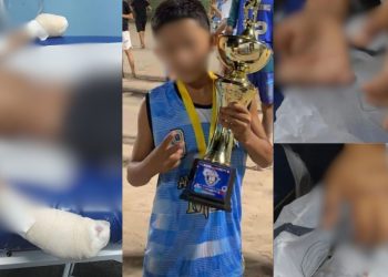 Imagens mostram como ficou as mãos do menino de 10 anos que teve os dedos decepados por facção em Manaus