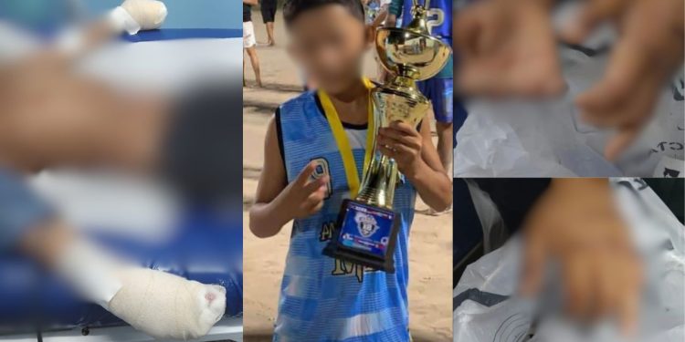 Imagens mostram como ficou as mãos do menino de 10 anos que teve os dedos decepados por facção em Manaus
