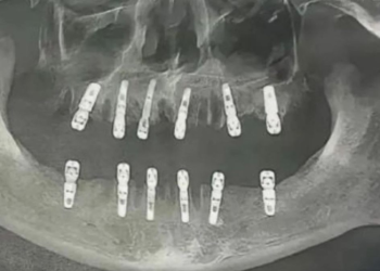 Um homem morreu 13 dias depois de extrair 23 dentes e implantar 12, na mesma cirurgia. O caso foi registrado. Homem