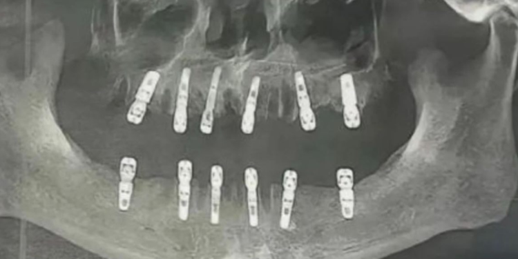 Um homem morreu 13 dias depois de extrair 23 dentes e implantar 12, na mesma cirurgia. O caso foi registrado. Homem