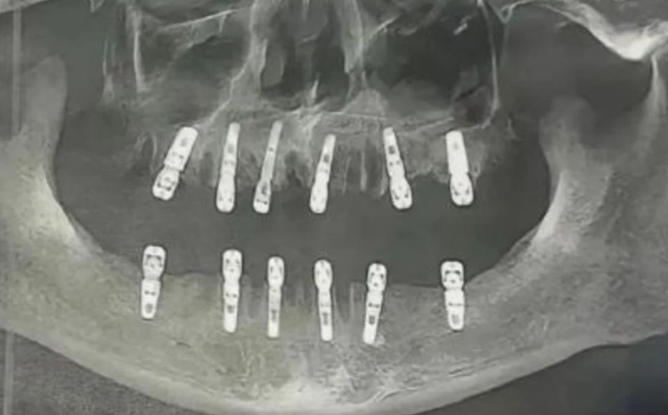 Um homem morreu 13 dias depois de extrair 23 dentes e implantar 12, na mesma cirurgia. O caso foi registrado. Homem