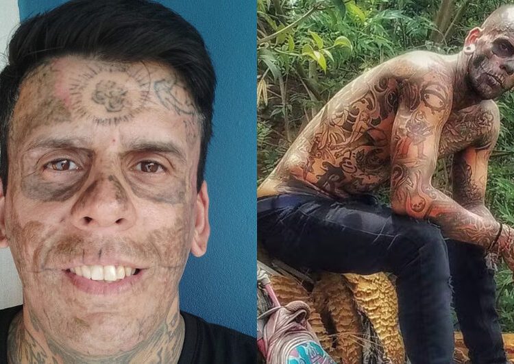 'Mais tatuado do Brasil' passa por 3ª sessão de remoção de tatuagens após se tornar evangélico