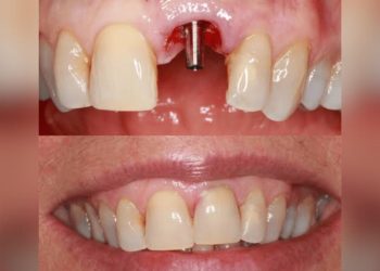 Adeus implantes dentários: Medicamento que regenera os dentes está em fase de testes