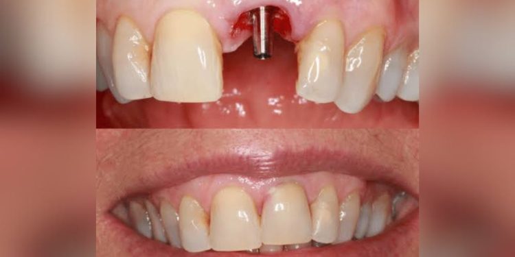 Adeus implantes dentários: Medicamento que regenera os dentes está em fase de testes