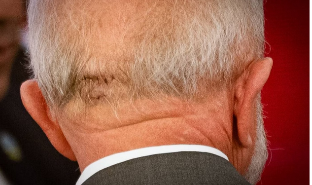 Lula passa por cirurgia de emergência e está na UTI