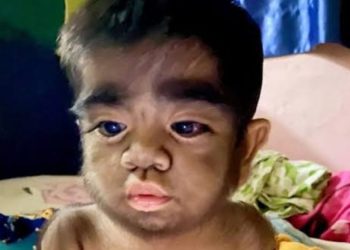 Nascimento de bebês com ‘síndrome de lobisomem’ acende alerta vermelho