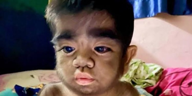 Nascimento de bebês com ‘síndrome de lobisomem’ acende alerta vermelho