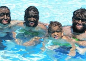 Doença transforma família em lobos