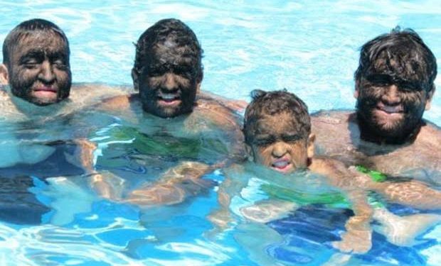 Doença transforma família em lobos