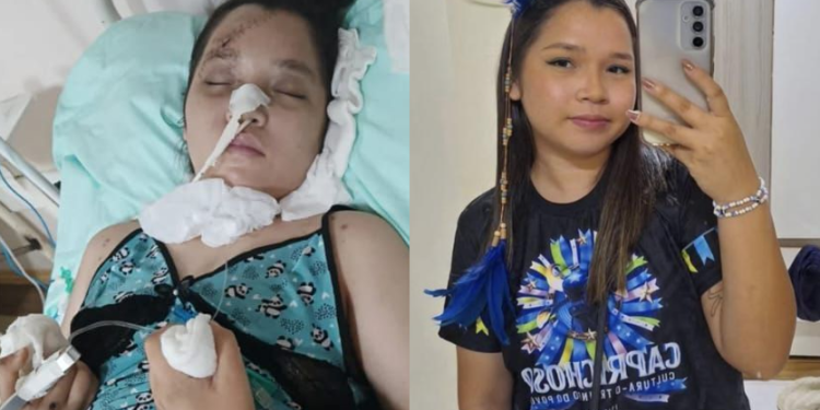 Caprichoso pede doações para universitária que continua internada em Manaus