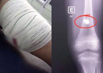 Criança de 7 anos é atingida por bala perdida enquanto dormia em Itacoatiara