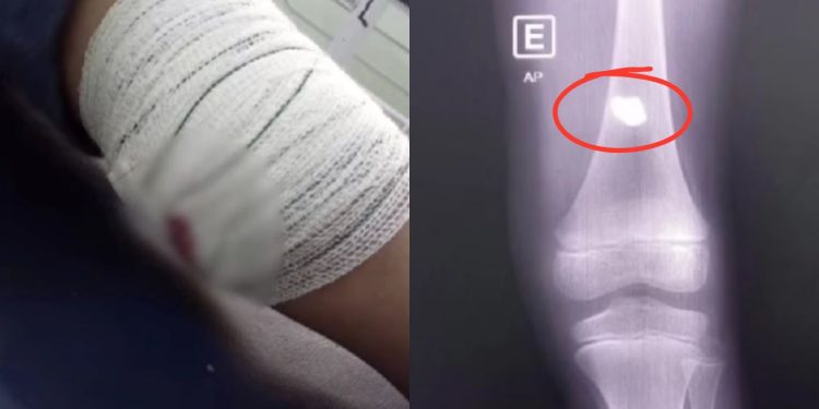 Criança de 7 anos é atingida por bala perdida enquanto dormia em Itacoatiara