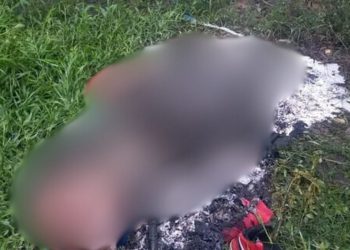 Veja como ficou o homem que foi carbonizado até virar carvão em Parintins