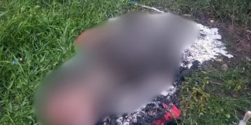 Veja como ficou o homem que foi carbonizado até virar carvão em Parintins