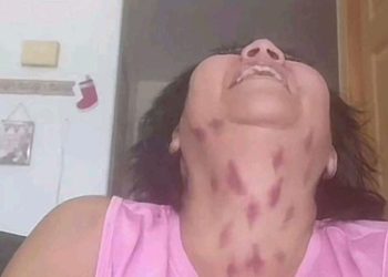 Beijo do Vampiro – Chupão no pescoço causa AVC