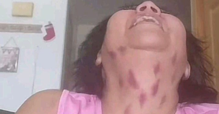 Beijo do Vampiro – Chupão no pescoço causa AVC