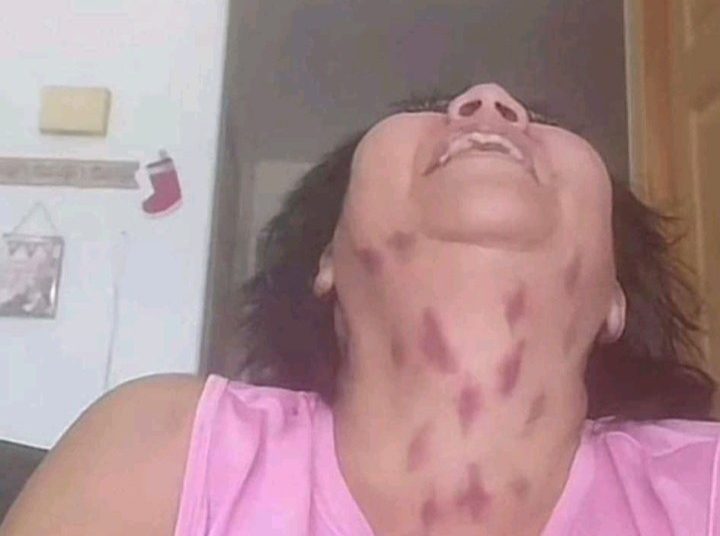 Beijo do Vampiro – Chupão no pescoço causa AVC