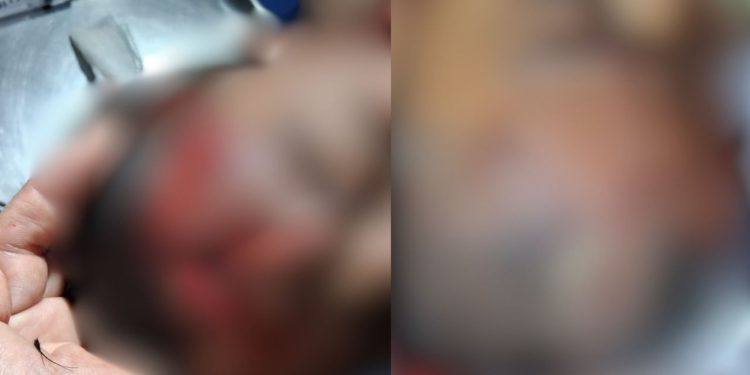 Ao pular no rio, criança bate a cabeça em tronco e fica com a testa aberta no AM