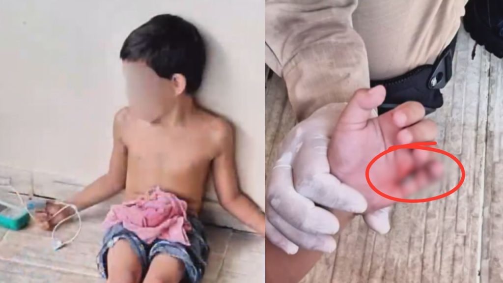 Ao cair em piscina, criança de 6 anos fica com gancho preso na mão em Manaus