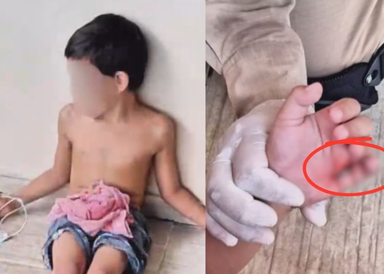 Ao cair em piscina, criança de 6 anos fica com gancho preso na mão em Manaus