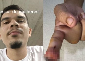 Polícia pede a prisão de homem que arranco a ponta do dedo da namorada na ‘dentada’ em Manaus