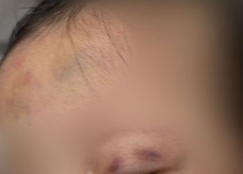 Drogado e bêbado, pai deixa os dois filhos cheios de hematomas em Manaus; VEJA  AS FOTOS