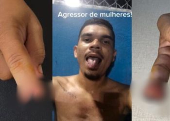 IMAGEM FORTE: Com ciúmes, homem morde e arranca a ponta do dedo da namorada em Manaus