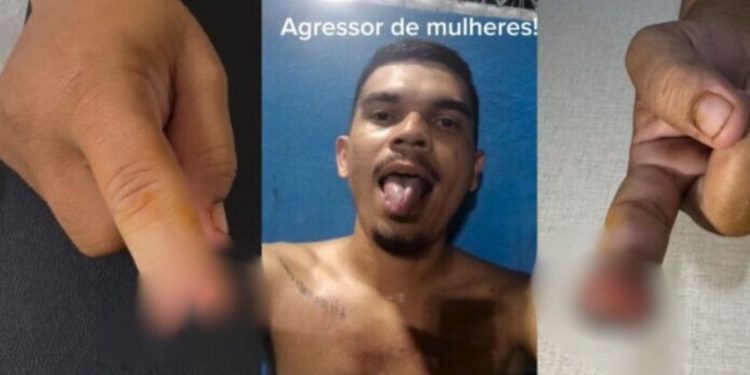 IMAGEM FORTE: Com ciúmes, homem morde e arranca a ponta do dedo da namorada em Manaus