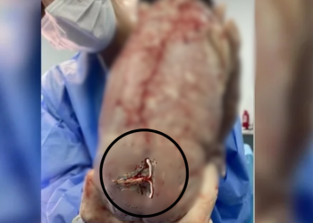 Bebê nasce com DIU preso ao corpo e imagem viraliza na web