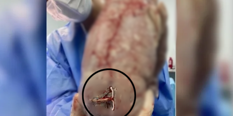 Bebê nasce com DIU preso ao corpo e imagem viraliza na web