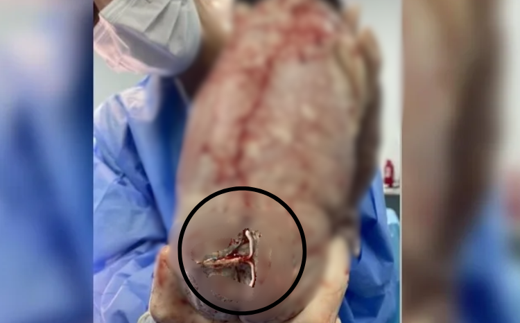 Bebê nasce com DIU preso ao corpo e imagem viraliza na web