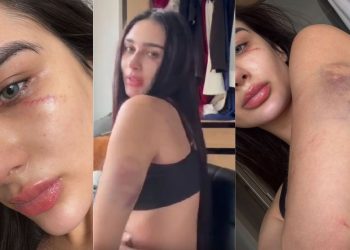 Miss Manaus acusa o ex de agressão e mostra o corpo roxo: "me deu murros"