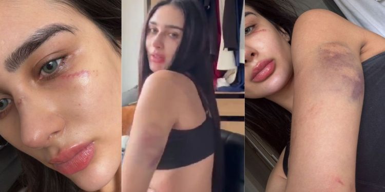 Miss Manaus acusa o ex de agressão e mostra o corpo roxo: "me deu murros"