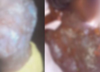 Criança que teve as costas queimadas pelo padrasto é transferida para Manaus