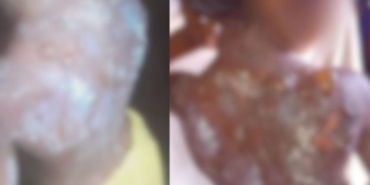 Criança que teve as costas queimadas pelo padrasto é transferida para Manaus