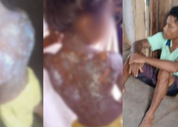 Em Autazes, criança de 6 anos tem as costas queimadas com mingau pelo padrasto