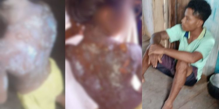 Em Autazes, criança de 6 anos tem as costas queimadas com mingau pelo padrasto